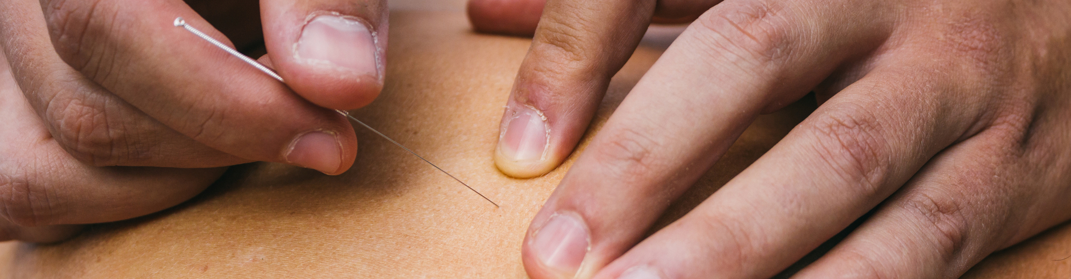 Met naaldjes je spieren versoepelen? Dry needling van Fysiotherapie de Brug;